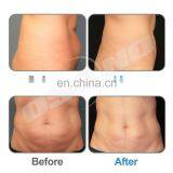 Freeze Contour 4 Handles Fat Freezing Device Cryo Sculpting Kryolipolyse Machine thumbnail-6