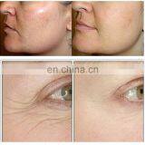 2018 New Arrivals Beauty Amazon Top Seller 2017 Medical Equipment Fashion Portable Machine Face Lifting Skin Rejuvenation thumbnail-5