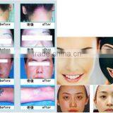 Laser Tattoo Removal Equipment 800mj Remove Pigment And Tattoo Machine 532nm / Q-switch Laser Tattoo Removal Machine Naevus Of Ota Removal Naevus Of Ito Removal thumbnail-5