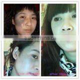 Spot Scar Pigment Removal Fractional Co2 Laser Sanhe Products Fractional 100um-2000um Face Lifting Co2 Laser /co2 Laser Surgery Machine Mole Removal thumbnail-2