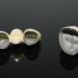 Dental Crown Porcelain Fused Metal, PFM, VMK, Dental Prostheses, Laboratoire Dentaire, Dentallabor, Laboratorio Dental, Dental Laboratory, Shenzhen LJ Dental Lab China thumbnail-4