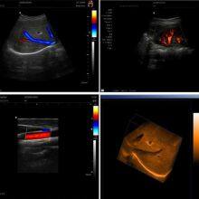 C20 Color Ultrasound Machine, Color Doppler thumbnail-5