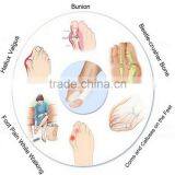 2016 Shuoyang Factory Wholesale Medical Silicone Soft Fabric Gel Hallux Valgus/bunion Toe Separator thumbnail-5