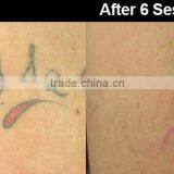 Q Switched Nd Yag Laser Tattoo Removal Machine New Design Tattoo Removal Q Switch Nd Yag Laser 1064nm thumbnail-5