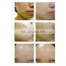 Vertical Hot Sale Skin Rejuvenation 7 Colorful Pdt Led Light Therapy Machine thumbnail-5