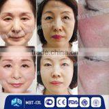 CE/ISO Approve Skin Care Beauty Machine for Wrinkle Removal and Face Lift Radio Frequency Machine thumbnail-4