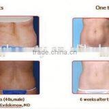 Portable Fat Freezing Fat Freeze Slimming Machine thumbnail-6
