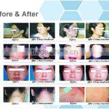 Warts Removal Rf Fractional Laser Co2 / Co2 Fractional Laser Skin Resurfacing Face Whitening / Fractional Co2 Laser Skin Resurfacing Machine Skin Regeneration thumbnail-6