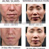 Hot Sale Radiofrequency Fractional RF Microneedle Laser Facial Rejuvenation Machine thumbnail-2