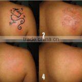Hottest nd Yag Laser Treatment Medical Device for Birthmark Removal thumbnail-5