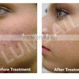 Laser Treatment Unit Photon BIO LED Light Therapy Machine PDT Red+ Blue +Infrared Light Therapy thumbnail-5