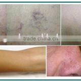 2015 China Newest Technology Diode Laser 980nm Machine / Laser Vascular Vein Removal / 980nml Aser Vein Removal Machine for Sale thumbnail-6