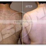 Germany Bars 808nm Diode Laser For Hair Removal Laser thumbnail-6