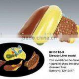 Disease Liver Model