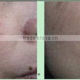 China Hair Salon Equipment Vascular Spider Vein Removal Machine thumbnail-4