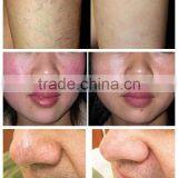 980nm Laser Spider Vein Stopper Laser Vascular Burner / Laser Vascular Burner thumbnail-5