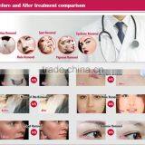 1500mj Best Seller Tattoo Laser Q Switch Nd Yag 1064nm thumbnail-6