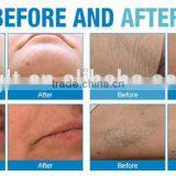 NEW Technology High Power Hair Removal E-light Ipl rf nd Yag Laser Multifunction Machine thumbnail-6