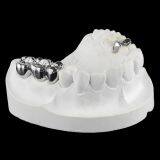 Full Metal Crown, FMC, FGC, Full Metal Post Core, Dental Crown, Cast Metal Crown, Dental Prosthesis, Laboratorio Dental, Dental Laboratory, Dentallabor, LJ Dental Lab China thumbnail-5