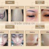 nd Yag Laser for Tatoo Removal Machine Q-switch Ng Yag Laser With Factory Price thumbnail-6