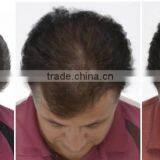 Good Effective Hair Loss Treatment Laser Cap Electric Scalp Stimulator/Ozone Treatment Hair Machine thumbnail-6