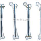 Humerus Interlocking Nail thumbnail-3