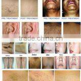 Portable Personal Laser Hair Removal Machine/ Laser Hair Removal Machine/ Home Laser Hair Removal Machine thumbnail-6