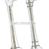 Humerus Interlocking Nail thumbnail-4