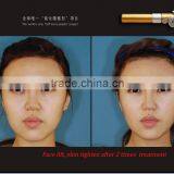 Portable Carboxytherapy Beauty Machine, Carboxytherapy Dark Eye Treatment, Co2 Therapy Equipment thumbnail-6