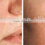 Laser Non Surgical Red Blood Removal, Laser Vein Removal thumbnail-4