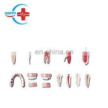 HC-S412 Dental Lesion Series Model/Dental Diseases Model, Lesion Teeth Model thumbnail-1