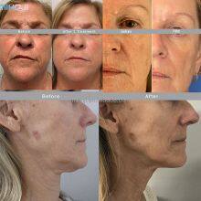 CE EEC FDA 2024 Morpheus 8 Beauty Machine With Ice Hammer thumbnail-2