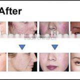 Shr YAG Laser Hair Removal Tattoo Removal Beauty thumbnail-2