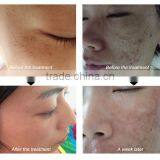 Acne Removal Device Fractional rf thumbnail-6