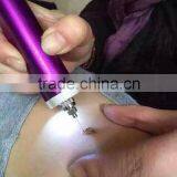 High Frequency Spot Removal Pen Speckle Removal thumbnail-5