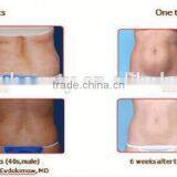 Fat Freezing Lipolaser Slimming Machine Portable on Hot Sale thumbnail-6