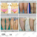 CE OD-S90 Vacuum Liposuction Cavitation Fat Reduction Body Contouring Machine for Aesthetic Clinic thumbnail-4