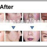 Painless Best Selling 3 in 1 Beauty Instrument 3 in 1 Machine Best Shr Ipl Machine Hair Removal thumbnail-4