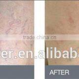 Blood Vessles Removal 980nm Red Blood Veins Removal Machine thumbnail-4