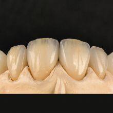 Digital-Crowns-Bridges Dental Laboratory in China thumbnail-5