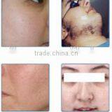 Skin Tightening Portable IPL Shr Hair Removal 640-1200nm Pigment Removal Machine Laser Ipulse Ipl Machine thumbnail-6