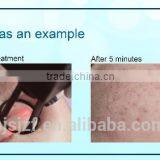F5 CO2 Laser/ Fractional Co2 Medical Laser/ Co2 Fractional Laser Equipment 10.6um thumbnail-5