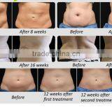 Cryolipolysis Slimming Machine/fat Body Slimming Freezing Cryolipolysis/cryolipolysis Machine Body Shaping thumbnail-4