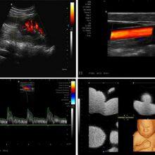 C20 Color Ultrasound Machine, Color Doppler thumbnail-4