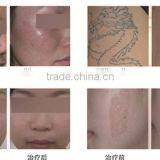 1064nm Pigment Removal Yag Laser Tattoo Removal Jundeli Hair Remover thumbnail-5