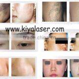 Tattoo Removal Q Switched Nd 1064nm Yag Laser Age Spots Removal Q Switch Laser Tattoo Removal thumbnail-6