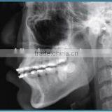 China Cheap Dental Panoramic and Cephalometric X-ray Machine thumbnail-6