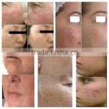 2016 Most Popular Beauty Equipment New Style SHR /IPL+elight Multifunctional IPL SHR thumbnail-5