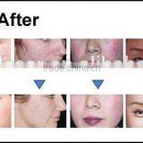 Screen Logo Customized Ipl Hair Removal, Shr Ipl Hair Removal, Ipl Hair Removal Machine Price thumbnail-4