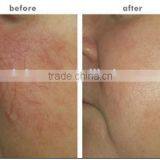 MBT 980nm Diode Laser for Vascular Lesions and Spider Veins Machine / Diode Laser Vascular Removal thumbnail-6